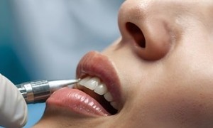 Najbolje metode za izbeljivanje potamnelih zuba